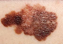 skin-cancer-causes-symptoms-types-treatment-prevention-tips-in-hindi