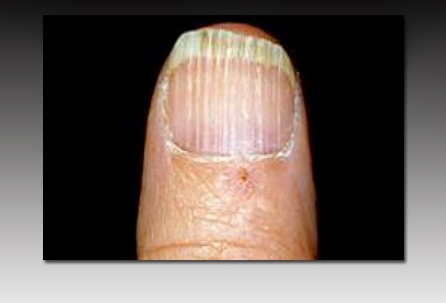 Vitamin deficiency fingernails - Awesome Nail