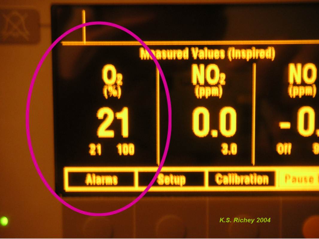FREMITUS Inhaled Nitric Oxide Setup for Nitric Oxide Challenge