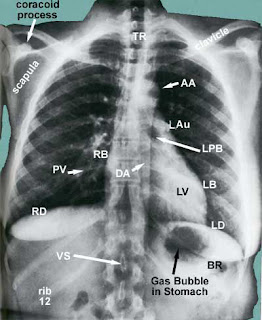 Gambaran Khas Radiologi Penyakit Sistem Respirasi