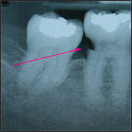 <Img src="radiografia-con-cuello-dañado-por-el-hilo-dental.jpg" width = "189" height "189" border = "0" alt = "Foto que muestra destrucción en el cuello de una muela provocada por el hilo o seda dental">