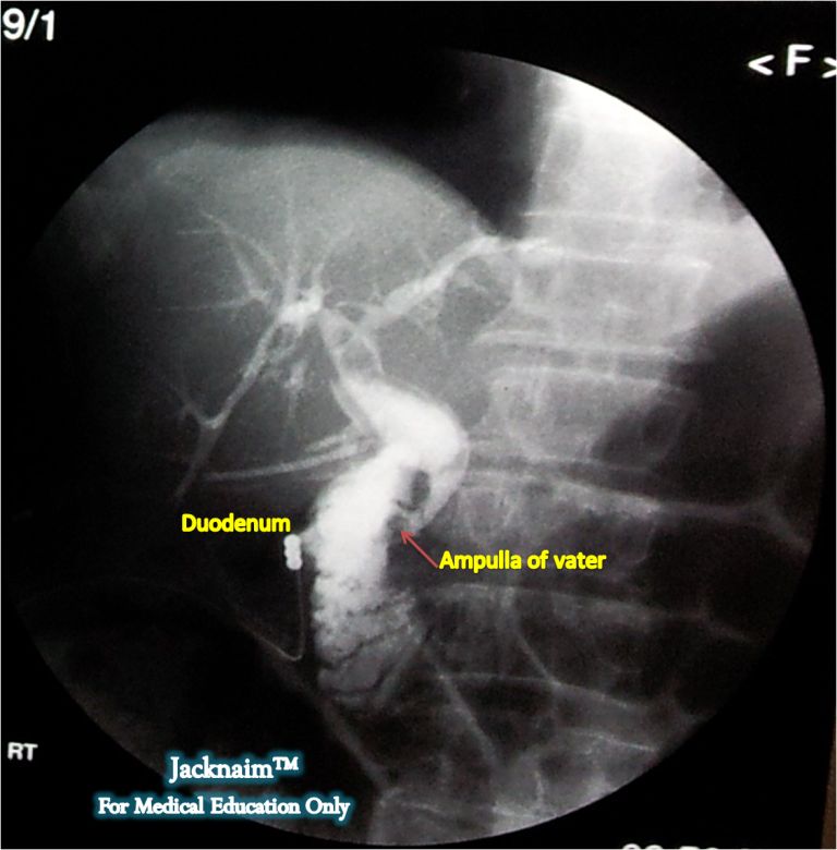 My Medical Notes: Image of the Day 6: Cholangiogram