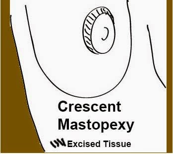 crescent mastopexy
