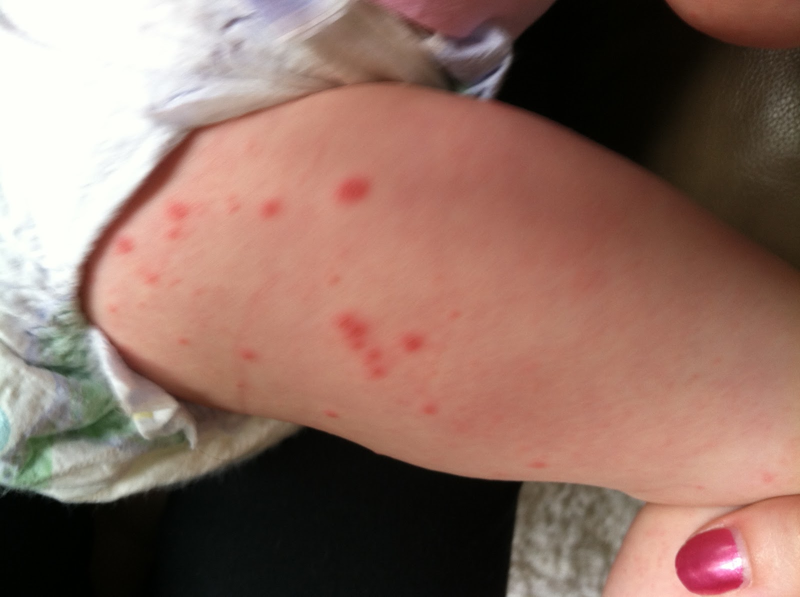 Hand-foot-and-mouth disease Symptoms - Mayo Clinic