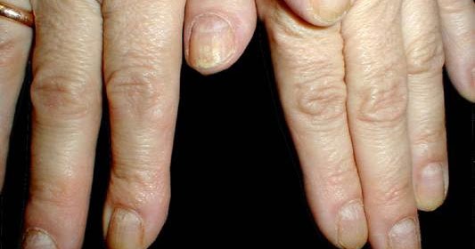 Nails Care: Alopecia areata (recurrent) with nail involvement Diseases