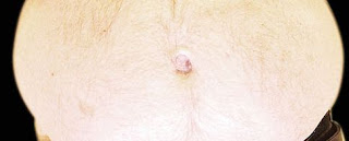 bukfetma%2Bframifr%25C3%25A5n - Gravidmage vs bukfetma - så lika men ändå så olika