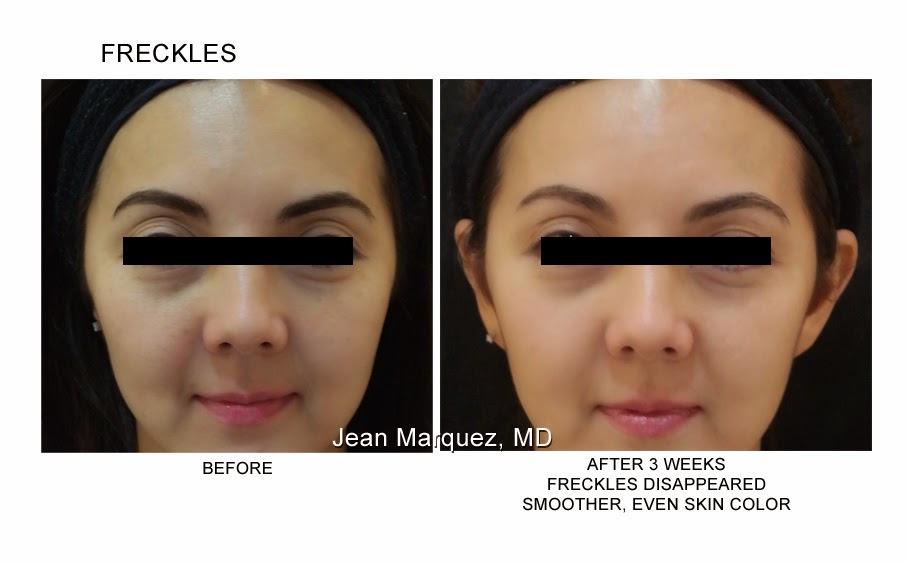 Feature The Skin Specialist's Erase Laser Dear Kitty Kittie Kath