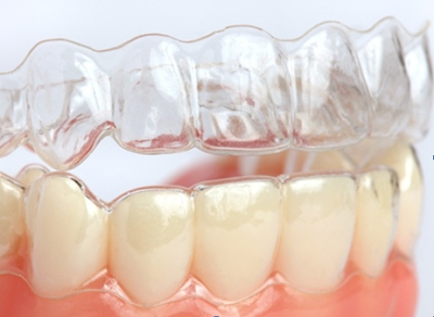 Chi phí niềng răng không mắc cài 3D Clear bao nhiêu?