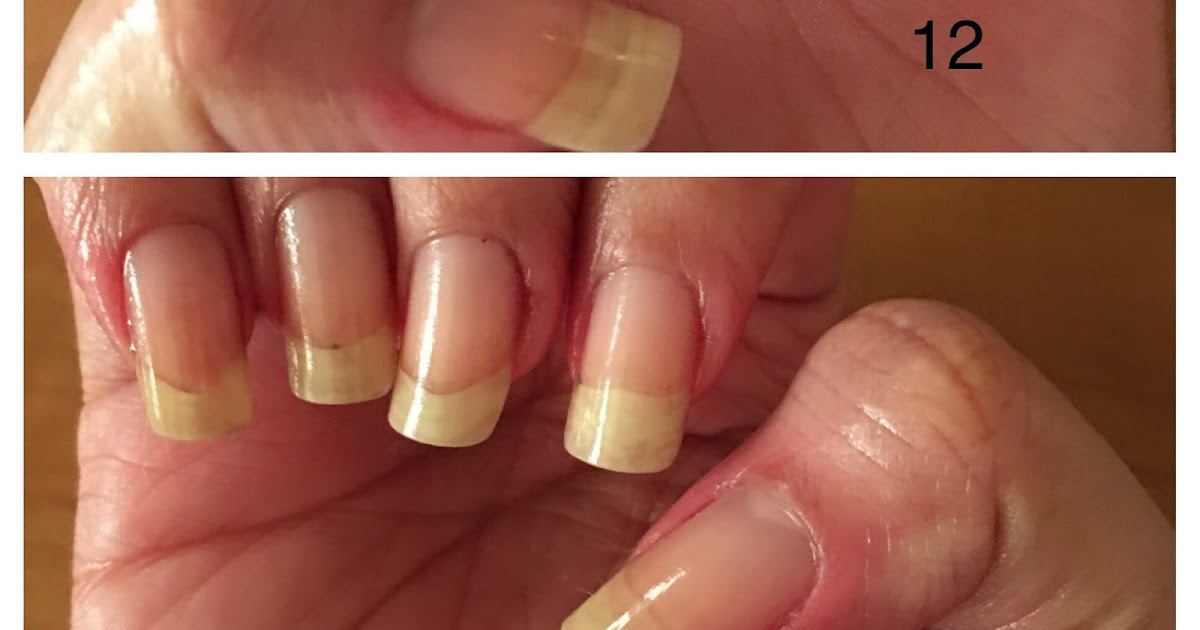 How to Save and Regrow Nails After a Break
