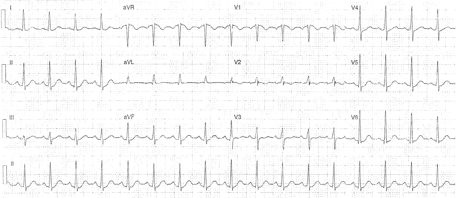 Синусовый и несинусовый ритм экг. Синусовый ритм qrs. Синусовый ритм qrs. Экг расшифровка синусовый ритм. Ритм синусовый pq.