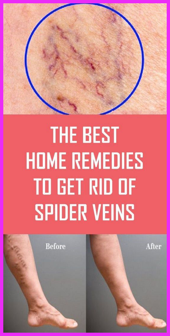 Spider Veins Will Be Remove By Using These Natural Methods!! Health
