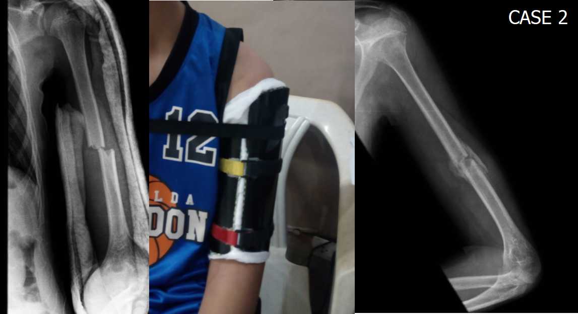 . MAKING HUMERAL FRACTURE BRACES USING PVC PIPES