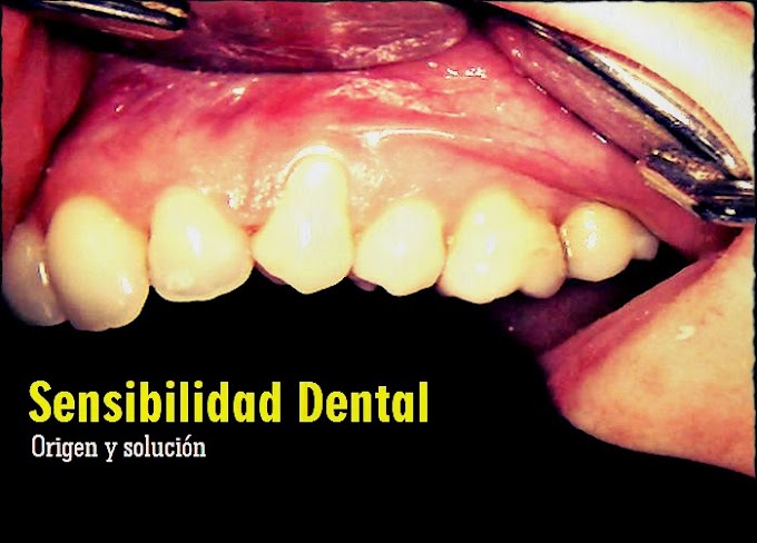 SENSIBILIDAD DENTAL: Origen y solución - Dr. Federico Miraglia