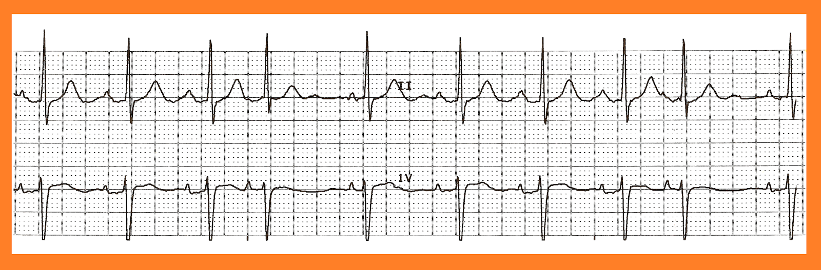 Practice EKG Strips 331