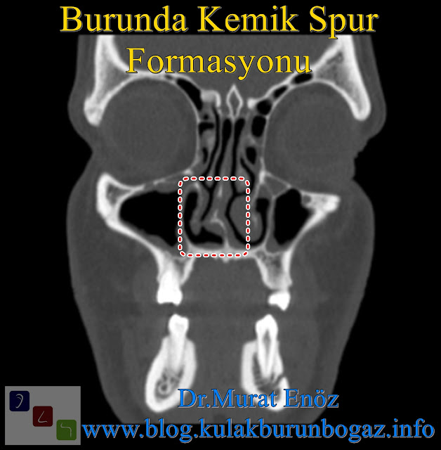What Is a Nasal Bone Spur? - Nasal Bone Spurs Surgery İstanbul - Nasal Bone Spur Treatment in Turkey - Symptoms of Nasal Bone Spur - Nose Bone Spur Formation - Contact Point Headaches - Diagnosis of Nasal Bone Spur - Removal of a Septal Bone Spur - Atypical Headache - Osteophyte - Bone Spur of Nose - Nasal Bone Spur - Bony Nasal Septal Spur