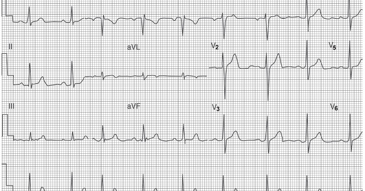 Study Medical Photos Understanding A Normal ECG Details about The