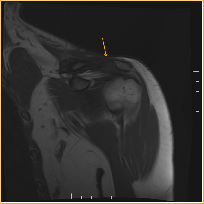 Suprascaular Neuropathy with Distal clavicle fracture Sumer's