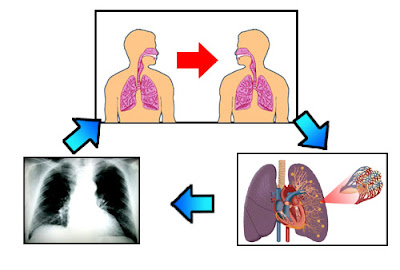 Obat Penyakit TBC Sesaknafas Paru Paru Kronis Denature