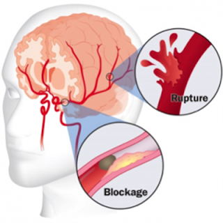 Cara Mengobati Stroke Ringan Dengan Bahan Alami, Genogram Penyakit Stroke, Cara Menyembuhkan Stroke Ringan Sebelah Kiri, Menyembuhkan Orang Stroke, Obat Herbal Pencegah Stroke, Data Penyakit Stroke Di Indonesia, Penyakit Stroke Darah, Obat Stroke Laminine, Obat Tradisional Untuk Mencegah Stroke, Ahli Mengobati Stroke, Mengobati Stroke, Penyakit Stroke Batang Otak, Terapi Pengobatan Stroke Hemoragik, Pengobatan Stroke Alternatif, Obat-Obatan Untuk Stroke Iskemik 