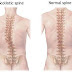 What is Levoscoliosis - Definition, Symptoms, Causes, Treatment
