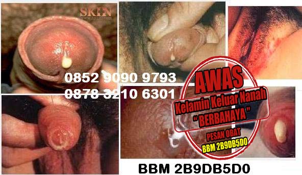 Cara Membuat Obat Tradisional Kencing Sakit Keluar Nanah Cara Membuat Obat Tradisional Kencing Sakit Keluar Nanah