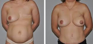 augmentation mammaire photo avant et après pour femme marié