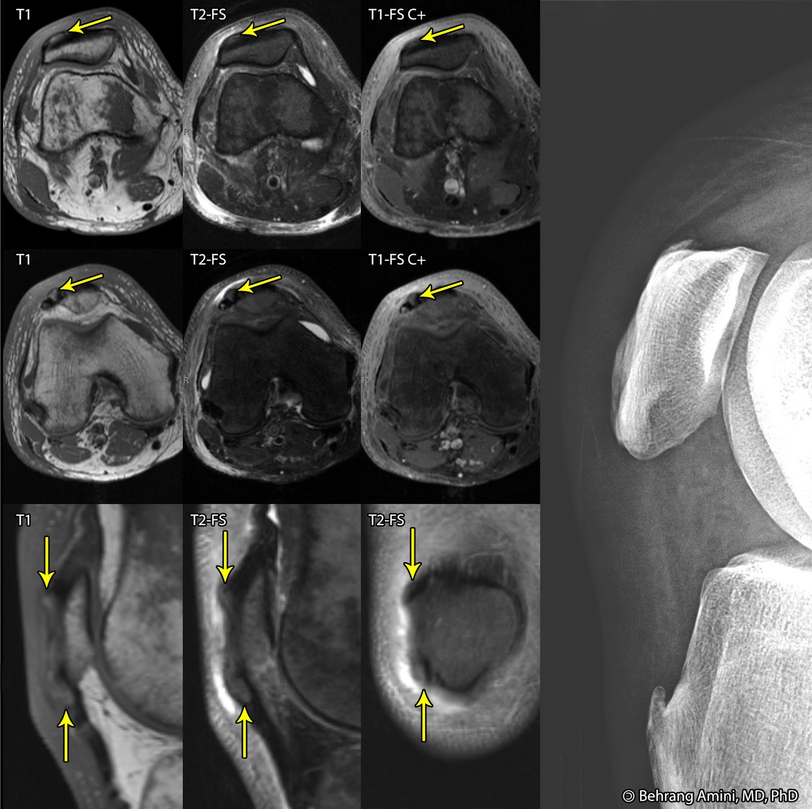 Roentgen Ray Reader Gout of the extensor mechanism of the knee