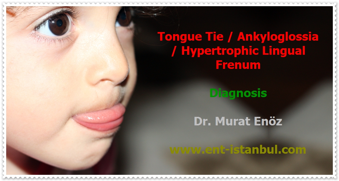 Tongue Tie (Ankyloglossia) Definition, Symptoms, Diagnosis and Treatment