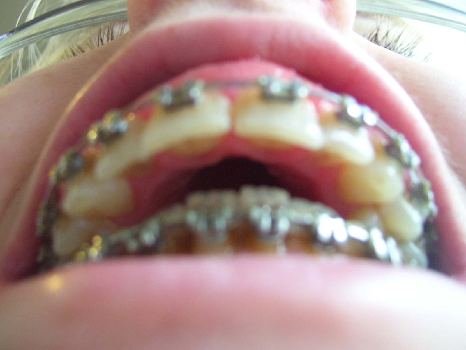 Icd 10 Code For Laceration Of The Skin Of The Jaw