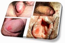 Jenis Obat Bagi Penyakit Sipilis Jenis Obat Bagi Penyakit Sipilis