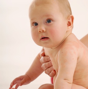 Eczemas em bebês | Clínica Weiss | Hugo Weiss Dermatologista