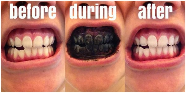 cara memutihkan gigi secara alami dengan cepat