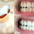 Phương pháp tẩy trắng răng hiệu quả hơn dầu dừa