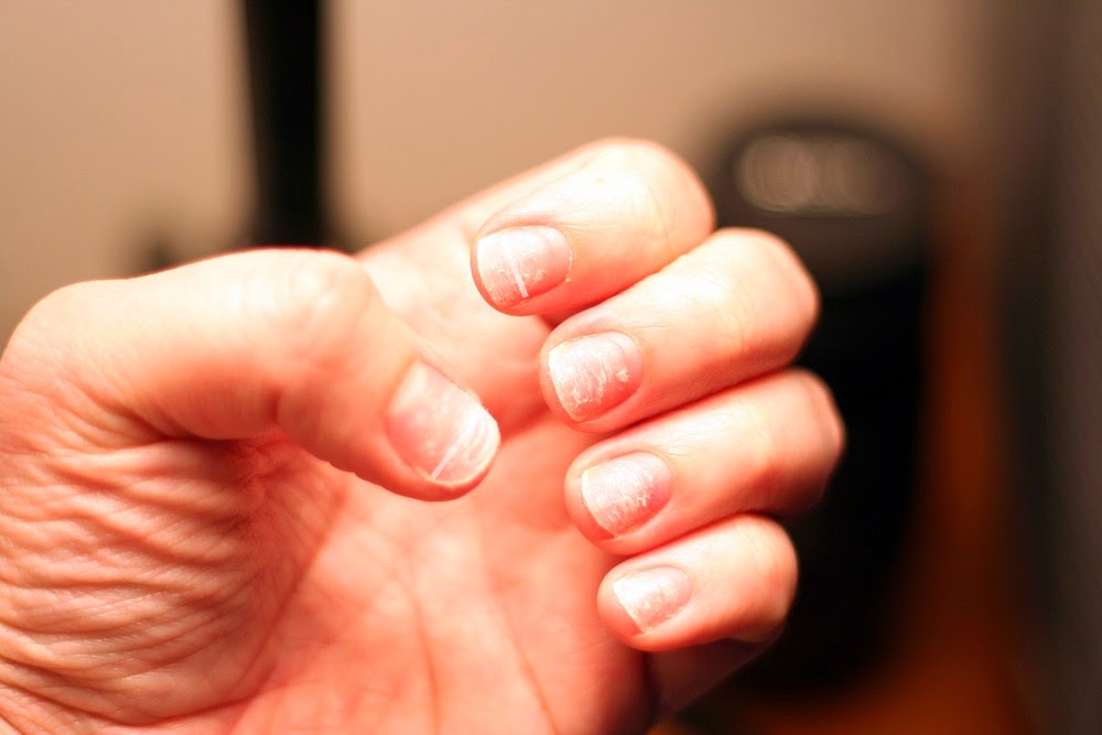 Fingernail and Toenail Abnormalities: Nail the Diagnosis