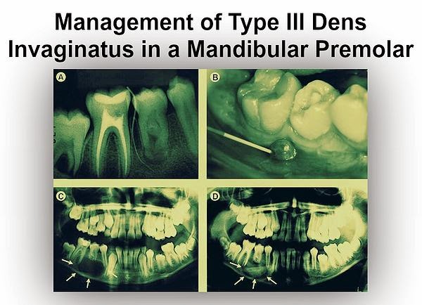 PDF: Management of Type III Dens Invaginatus in a Mandibular Premolar