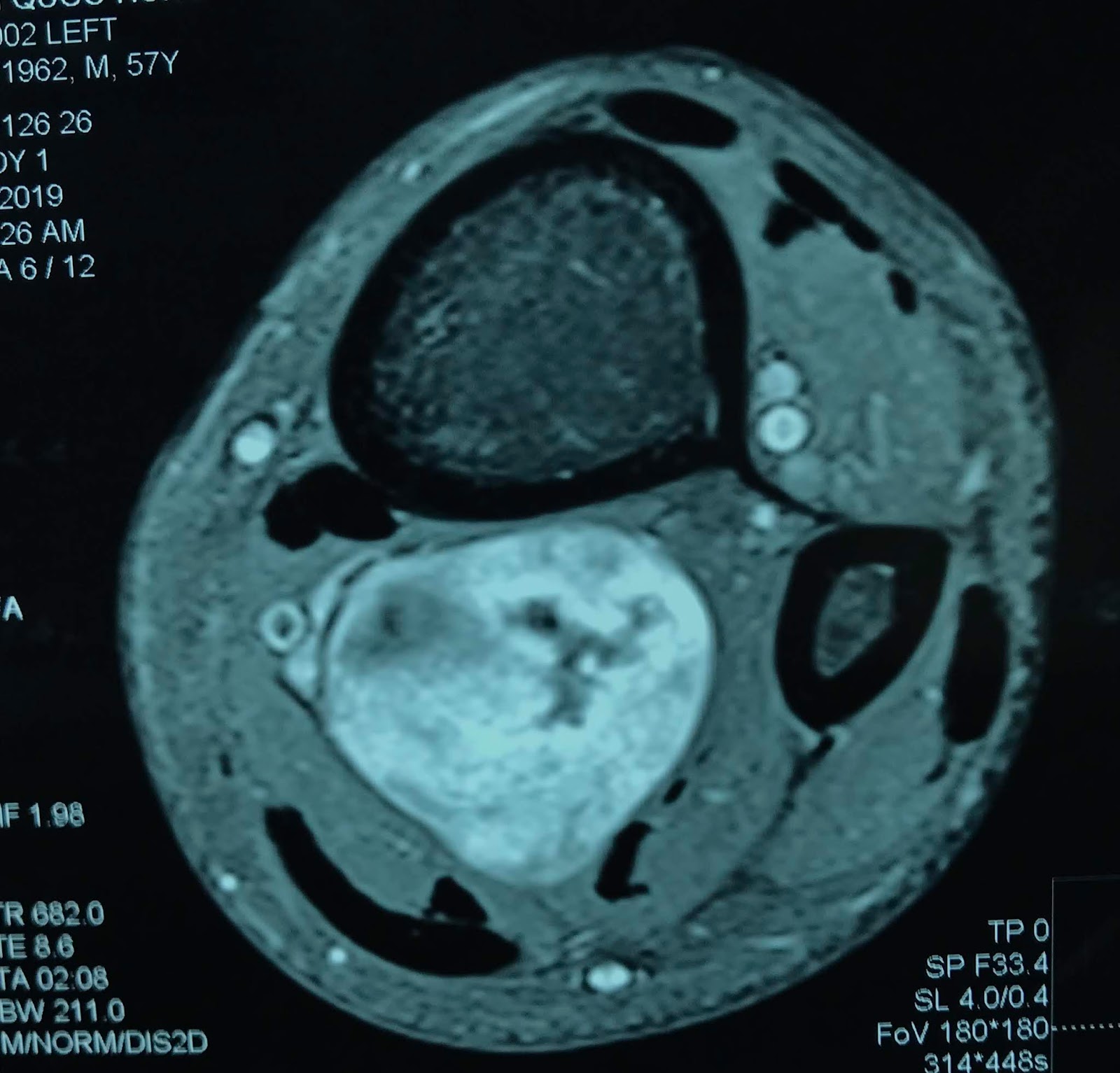 VIETNAMESE MEDIC ULTRASOUND CASE 535 LOWER LEG TUMOR, Dr PHAN THANH