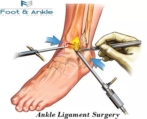 Ankle Ligament Surgery