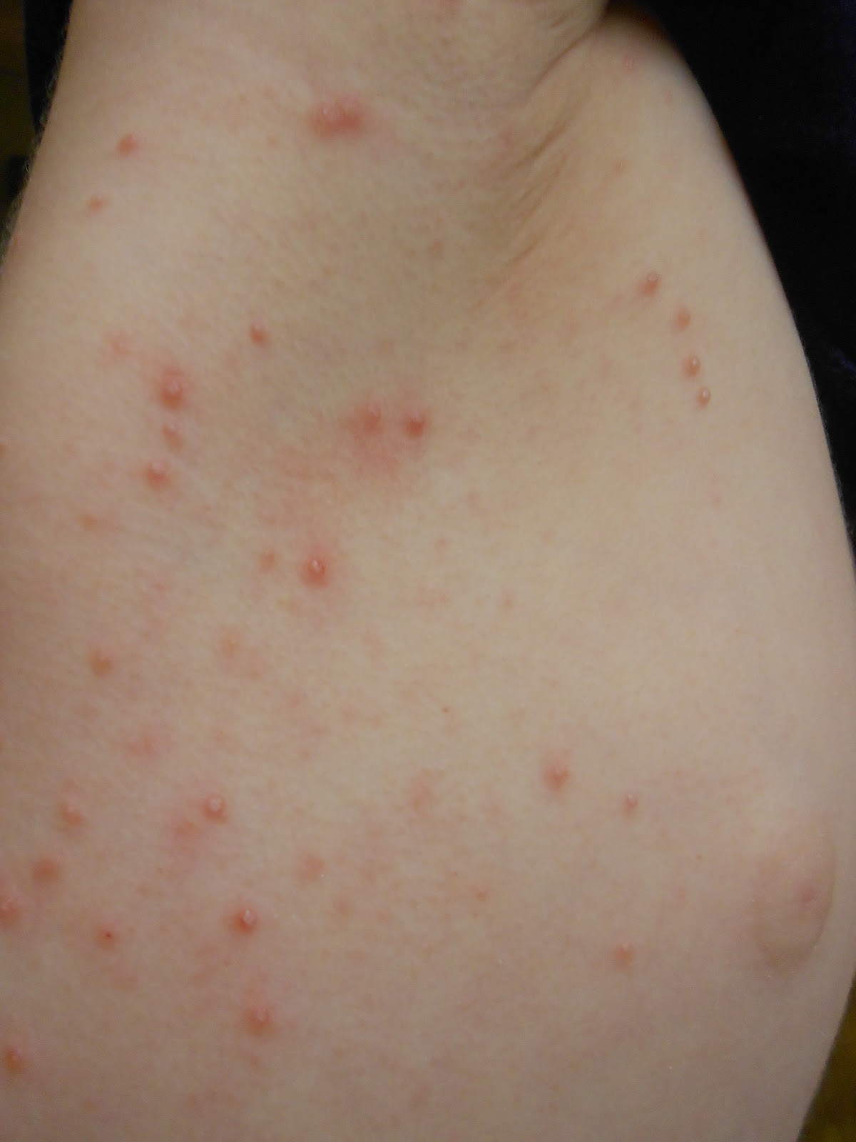 Roseola (Sixth Disease) Symptoms, Treatment & Pictures
