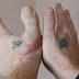 El hombre que le amputaron del dedo gordo del pie para ponérselo en la mano.