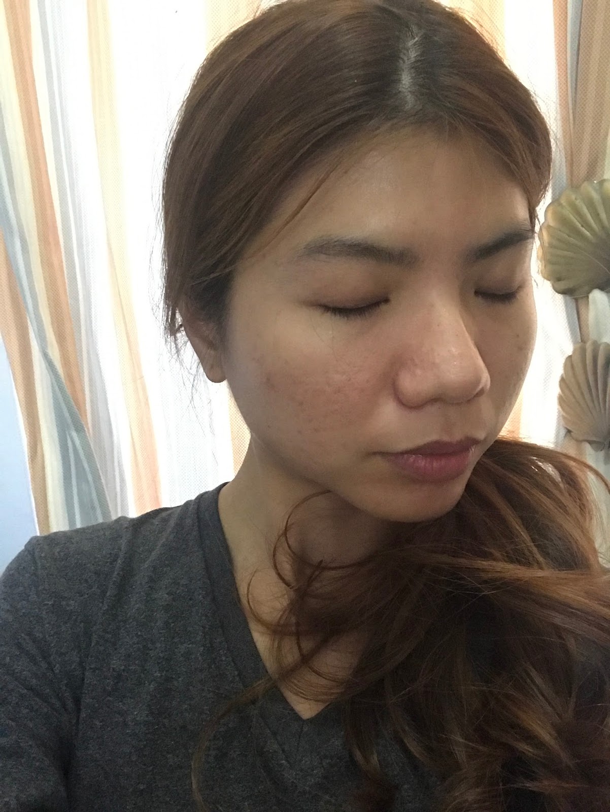 Laser for Acne Dual Yellow Laser Skin Gym SS2 J & D Learn to Blog