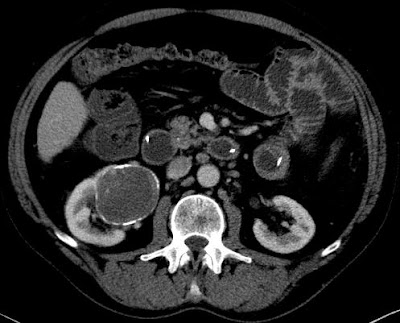 Echynococcus cysta a vesében