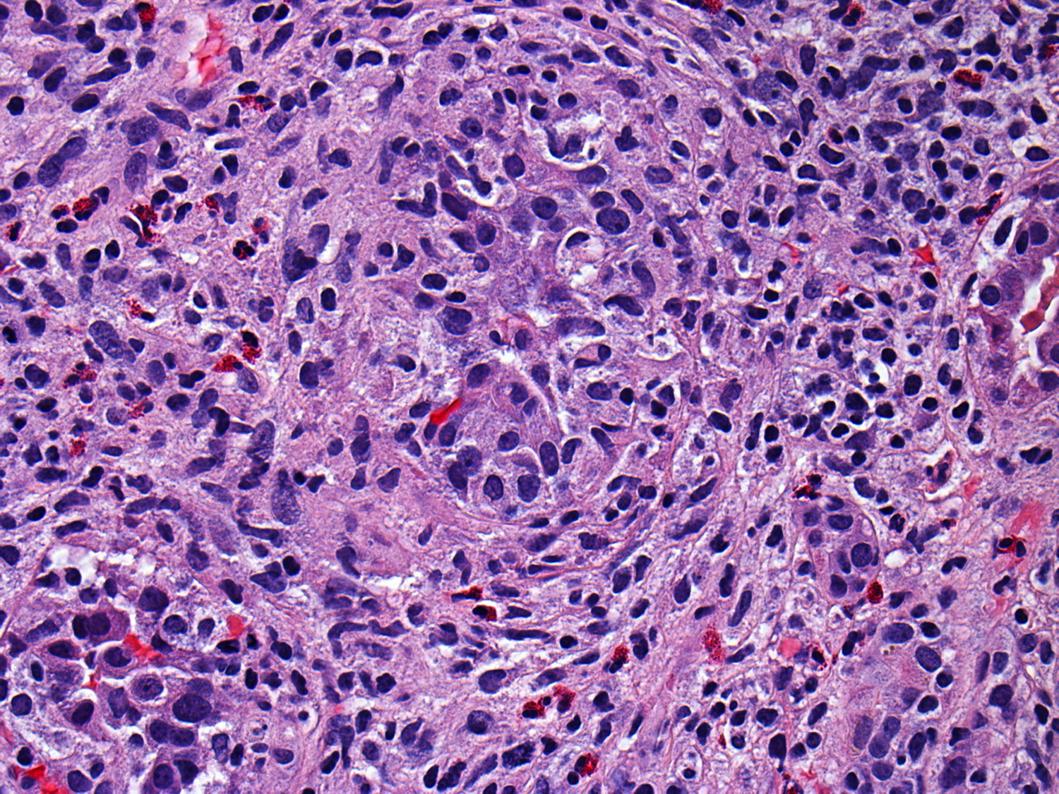 Renal Fellow Network An Atypical Form Of Renal Failure Granulomatous