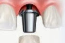 Preços de Implantes