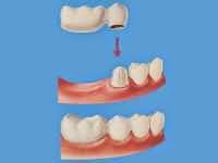 Τι είναι η οδοντιατρική γέφυρα και τι πρέπει να προσέχουμε; Image2