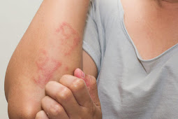 How to Treat Skin Irritation