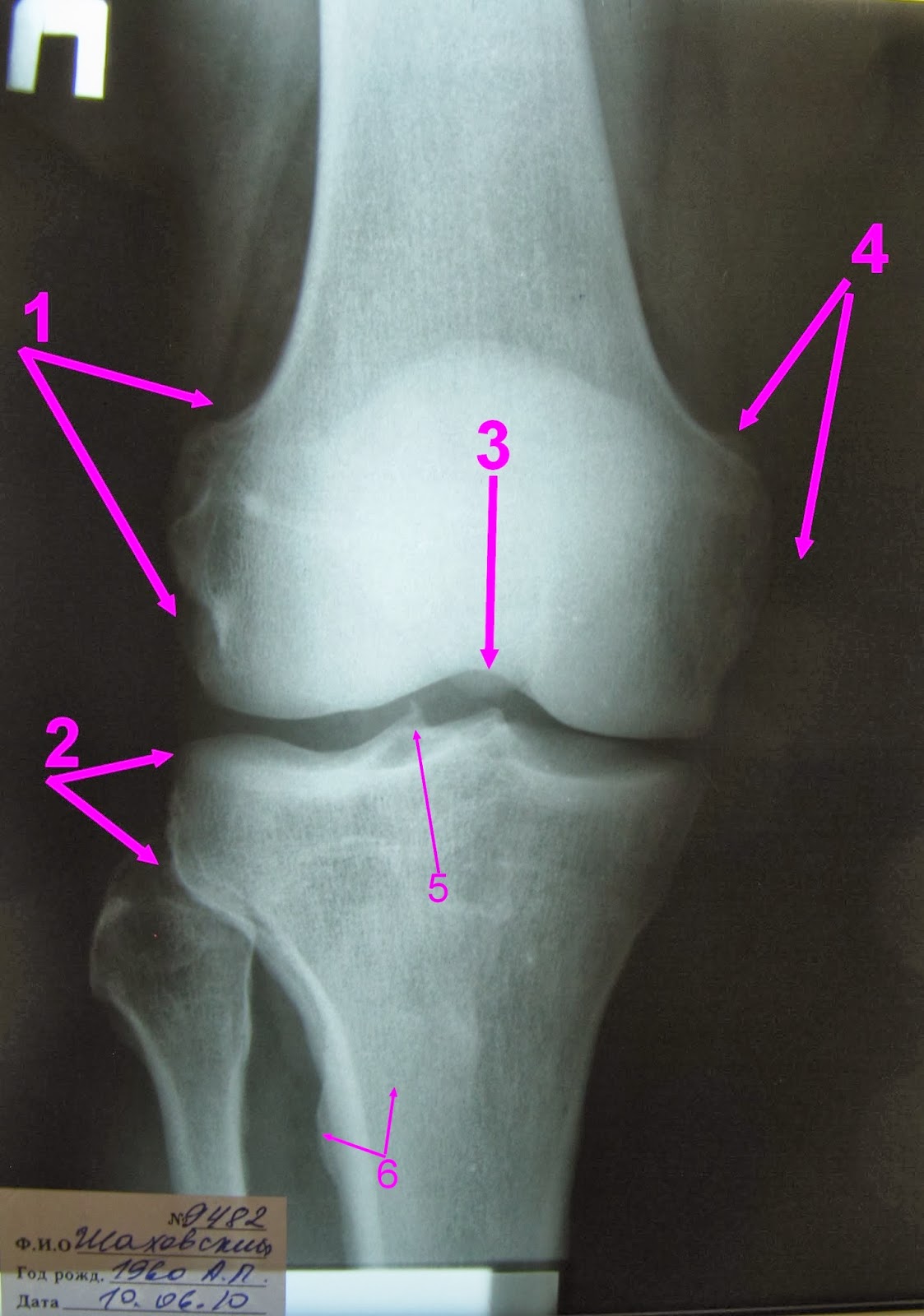 Латерального мыщелка. Мыщелки коленного сустава. Медиальный мыщелок коленного сустава. Мыщелок коленного сустава большеберцовой кости. Перелом медиального мыщелка коленного сустава.