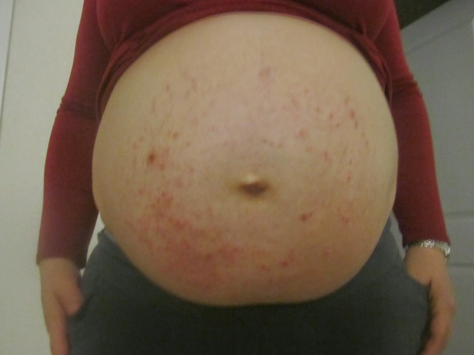PUPPPs - the pregnancy rash you never wanted