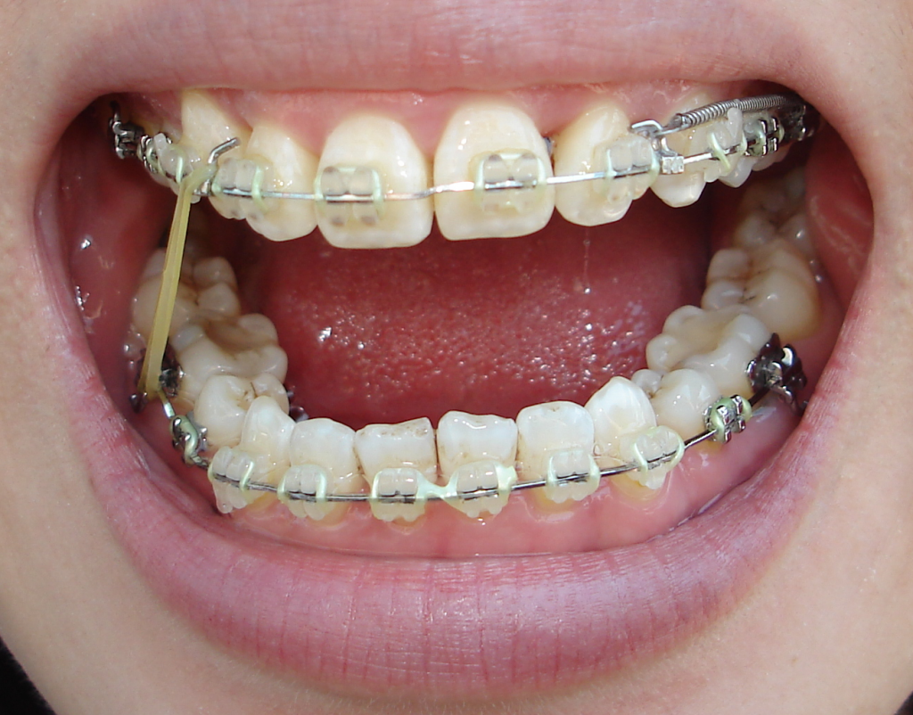 Orthofill Teeth gap band