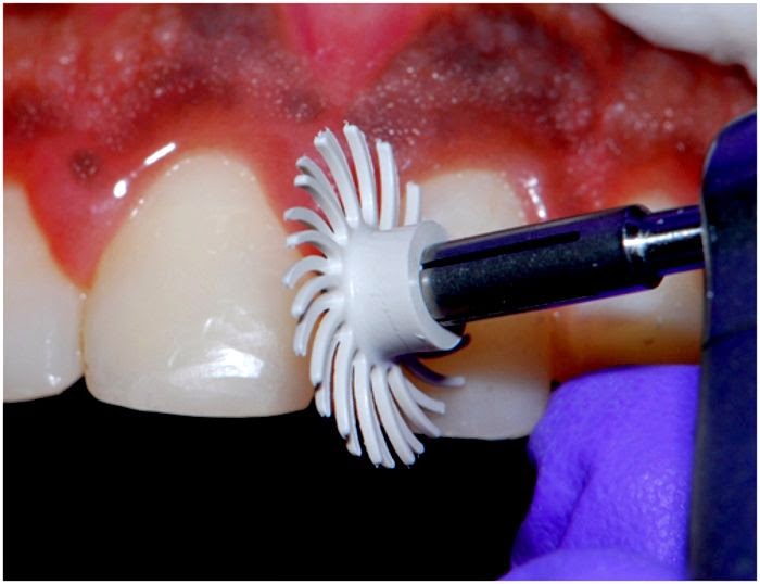 DENTAL MATERIALS Posterior Restoration using Filtek Restoratives
