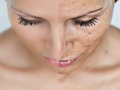 Stop a las manchas en el rostro | Beauty